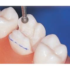 Fraises diamantés FGXL 801 5 pcs - EDENTA