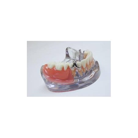 Résine acrylique autopolymérisante pour la fabrication de couronnes et bridges provisoires VILLACRYL STC - EVERALL7