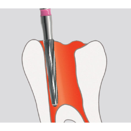 Fraise endodontique FG 5pcs - EDENTA