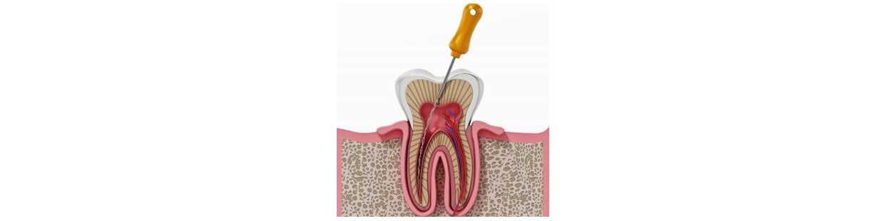 Endodontie : traitement de canal pour sauver vos dents